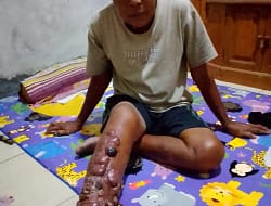 Sulaeman, Warga Kp. Jaringao yang Berjuang Melawan Penyakit Langka
